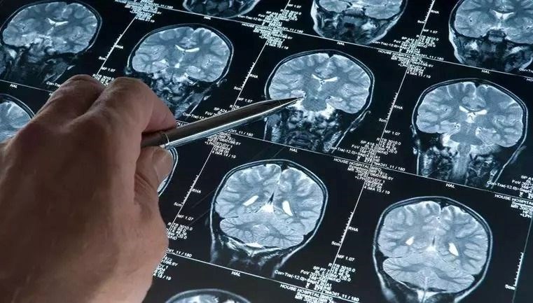 Uyku ilacı ve Alzheimer: Proteinlerin birikimini azaltabilir